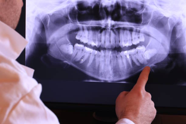 Best Knocked-Out Tooth (Avulsed Tooth) Treatment in Litchfield Beach, SC